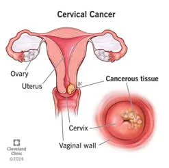 Cancer Moonshot Initiative explained for UPSC