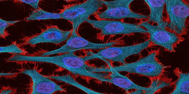 Cervical cancer
