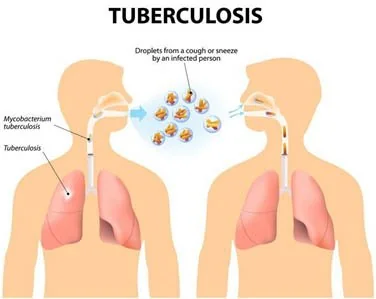 Global TB Report 2024 : India Performs explained for UPSC