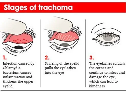 India Eliminates Trachoma : WHO explained for UPSC