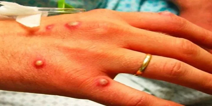 Mpox Outbreak explained for UPSC