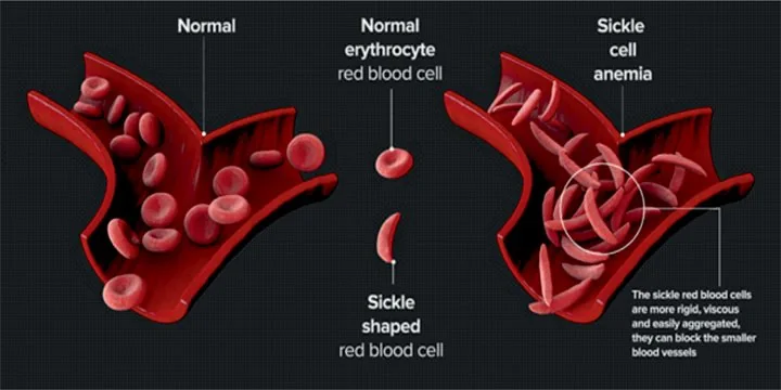 Sickle cell breakthrough