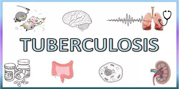 Tuberculosis