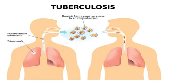 Tuberculosis