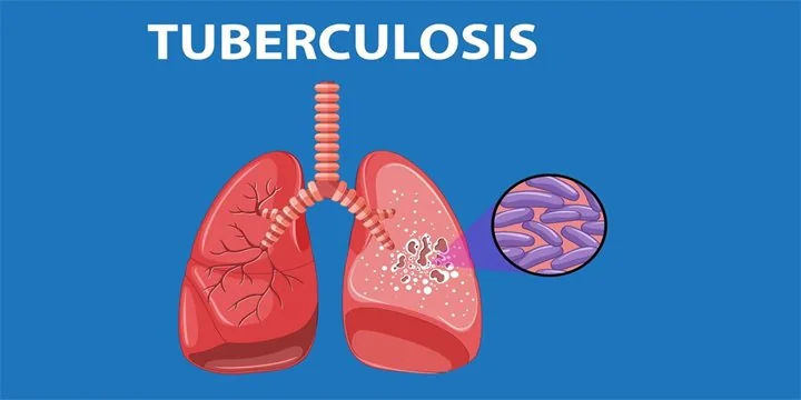 Tuberculosis